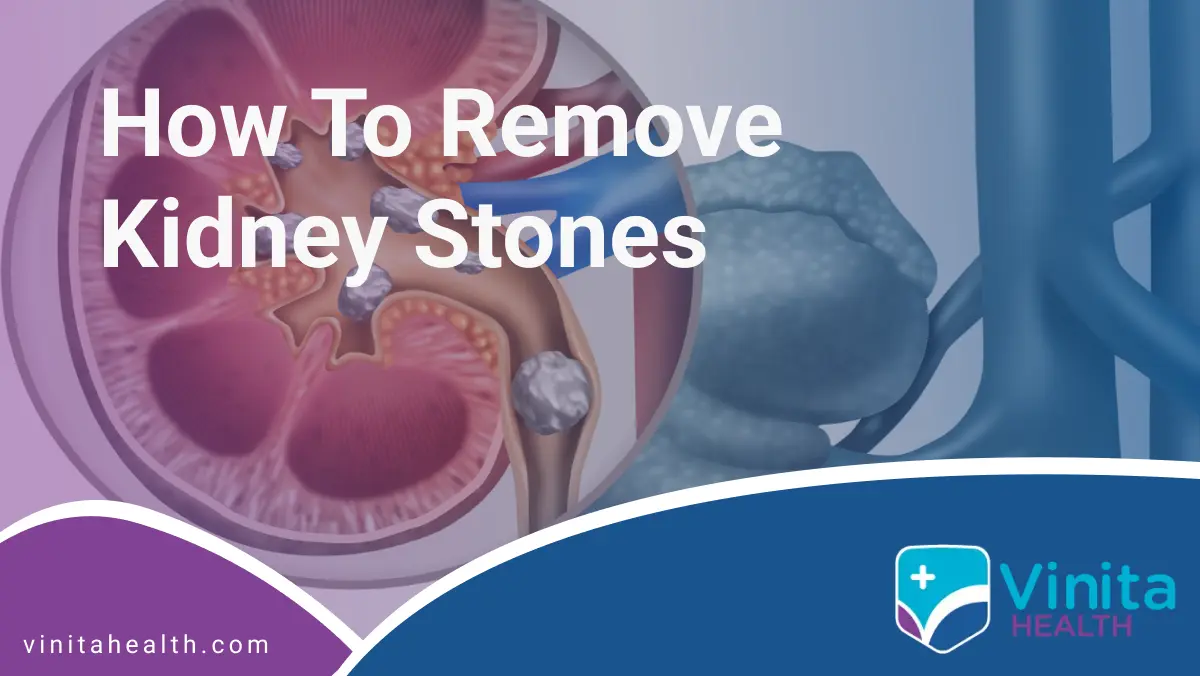 How to Remove Kidney Stones